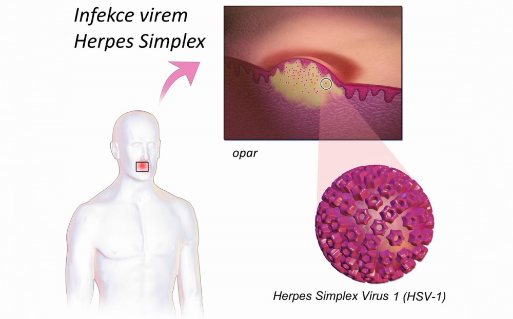 Herpes Simplex Virus, HSV1, opar - Pleva