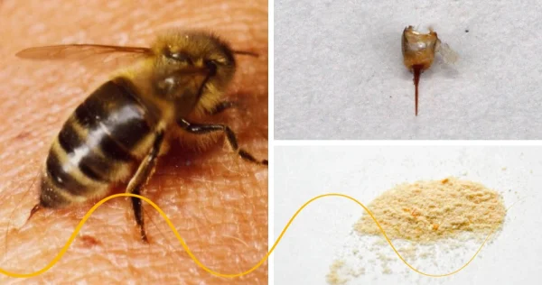 Bee sting – first aid