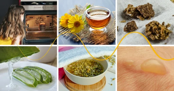 Burns and Scalds, their Treatment, and Help from Nature