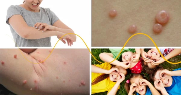 Molluscum Warts most Commonly Affect Children under 8 Years of Age