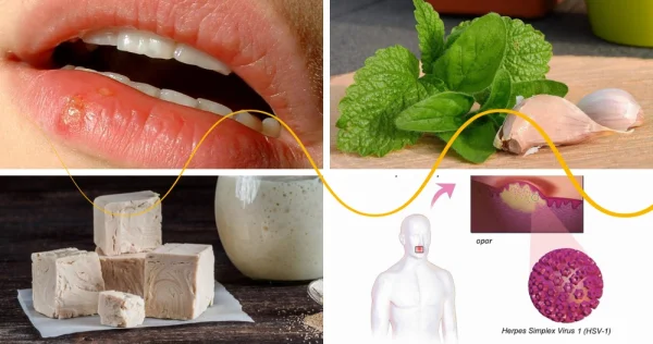 Herpes – prevention and natural remedies can help