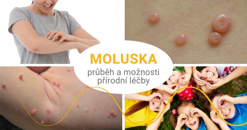 Moluska trápí nejčastěji děti do 8 let věku