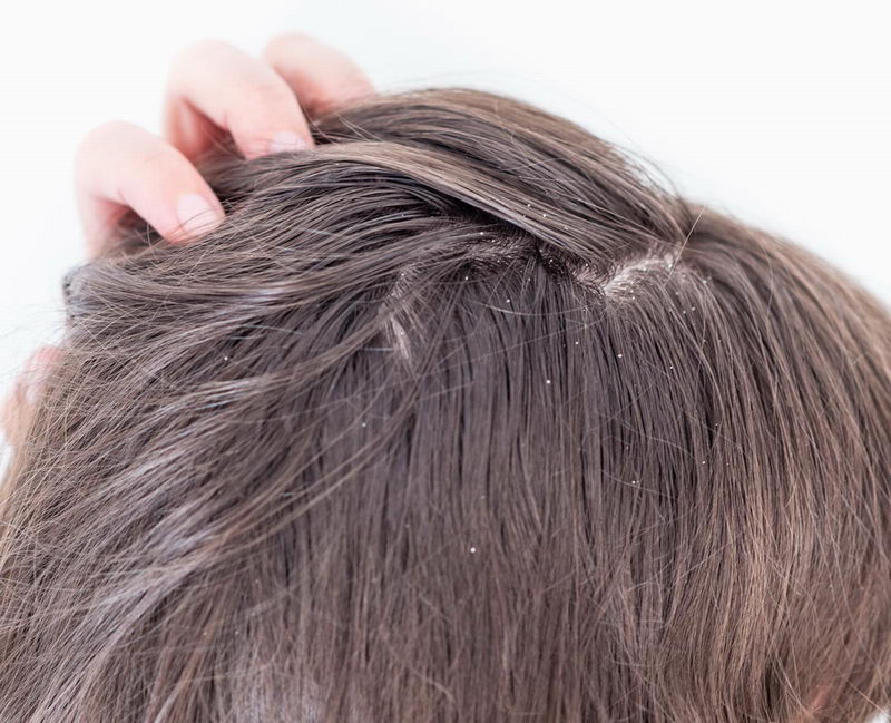 Lupy ve vlasech - proč vznikají a jak se jich zbavit