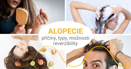 Alopecie aneb Proč mi pořád padají vlasy?