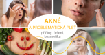 Problematická pleť a akné – příčiny, řešení, kosmetika