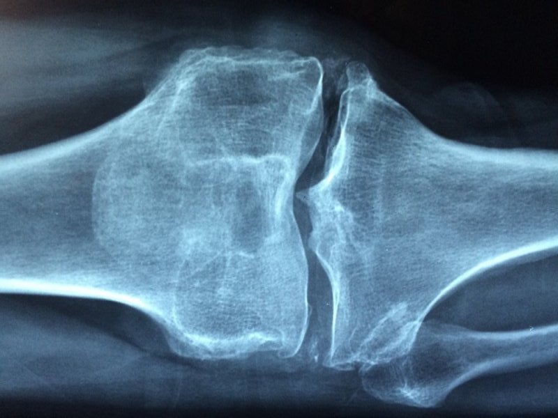Bolestivá kolena