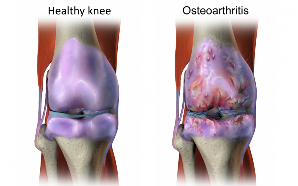 osteoartritida