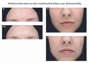Phycosaccharide AC, léčba akné, Pleva