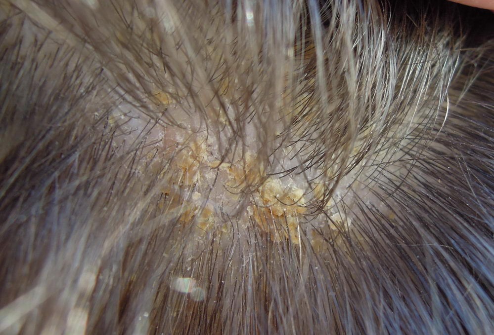 seborea, seboroická dermatitida ve vlasech